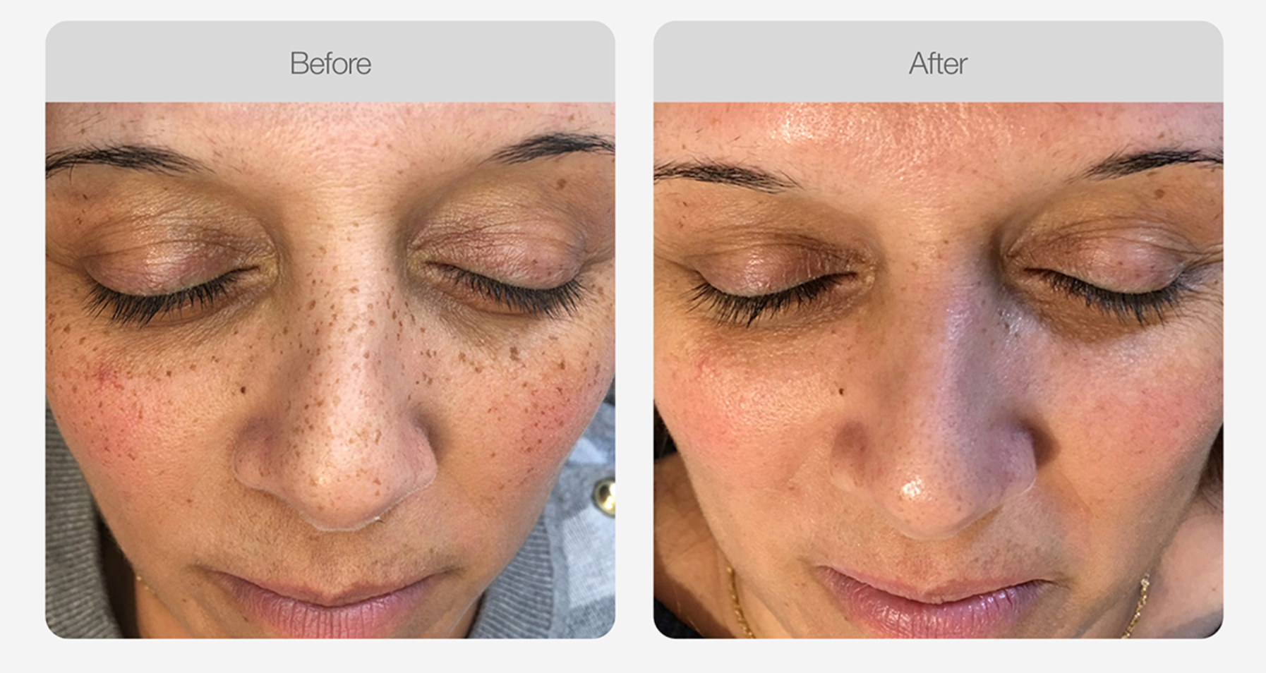 Pigmentation Skin Tone Correction