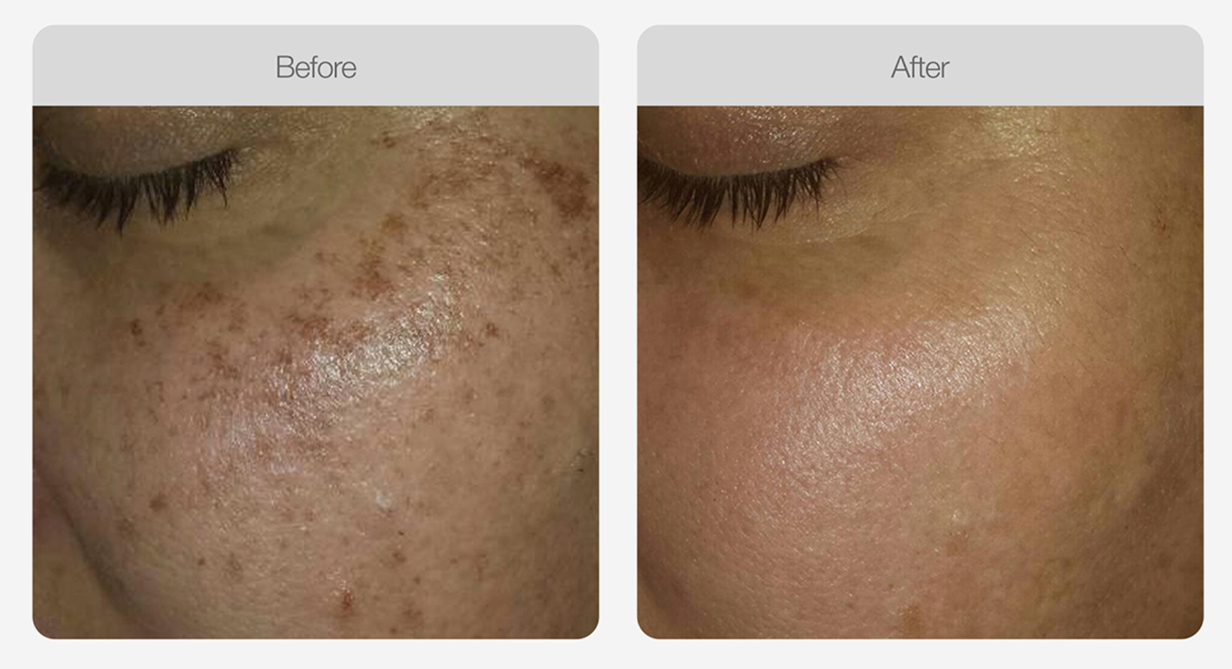 Pigmentation Skin Tone Correction
