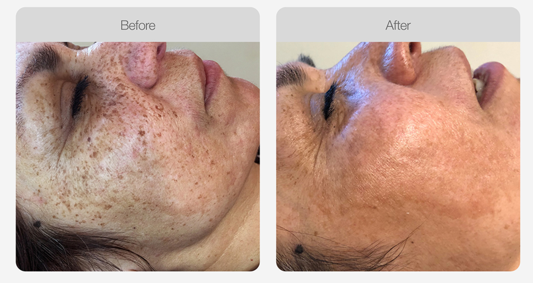 Pigmentation Skin Tone Correction