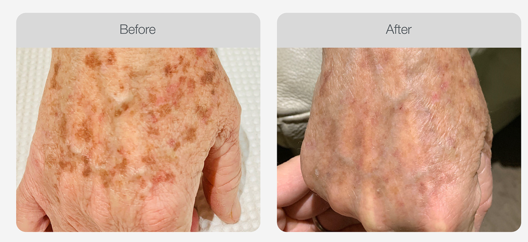 Pigmentation Skin Tone Correction