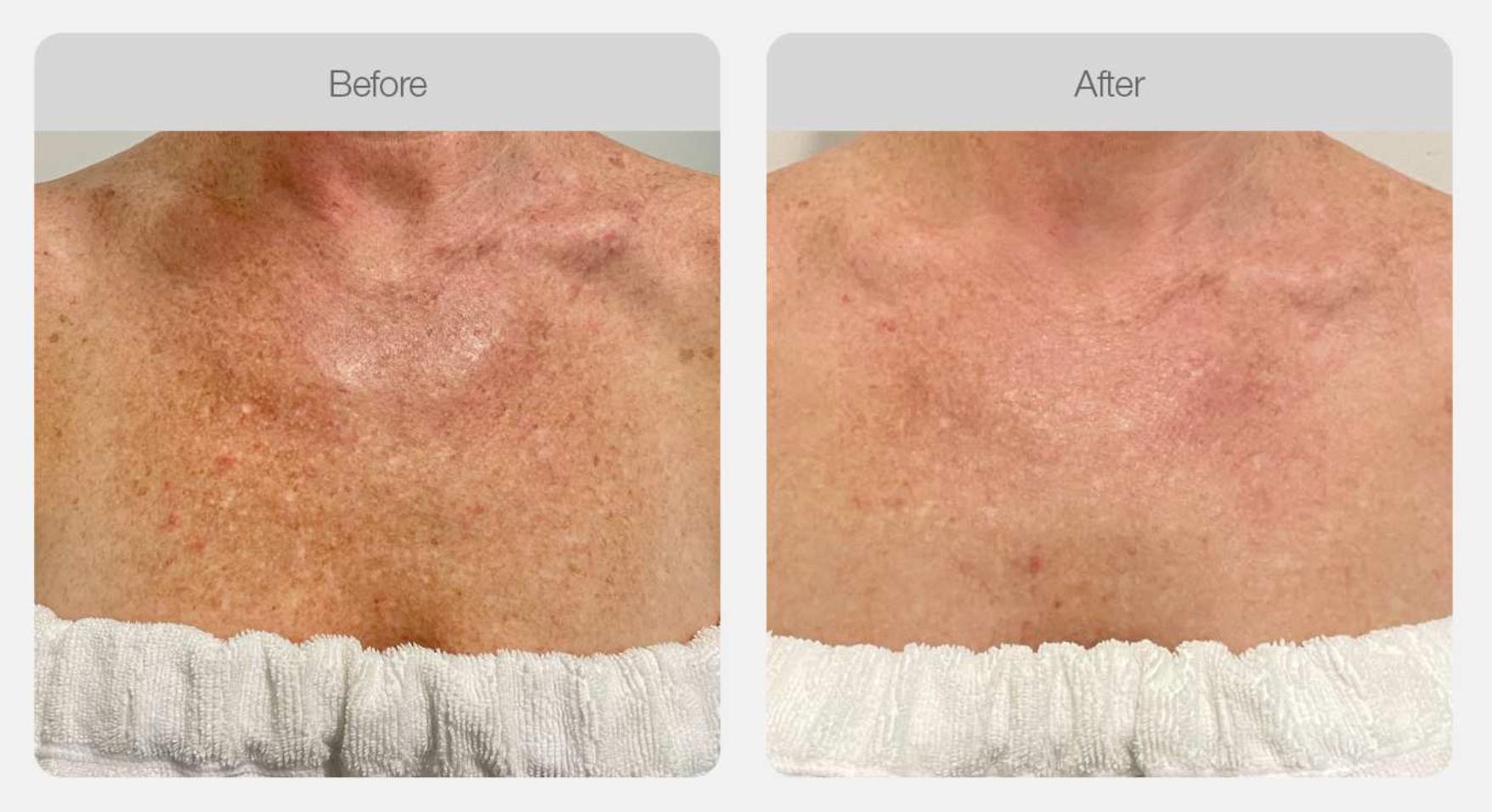Pigmentation Skin Tone Correction