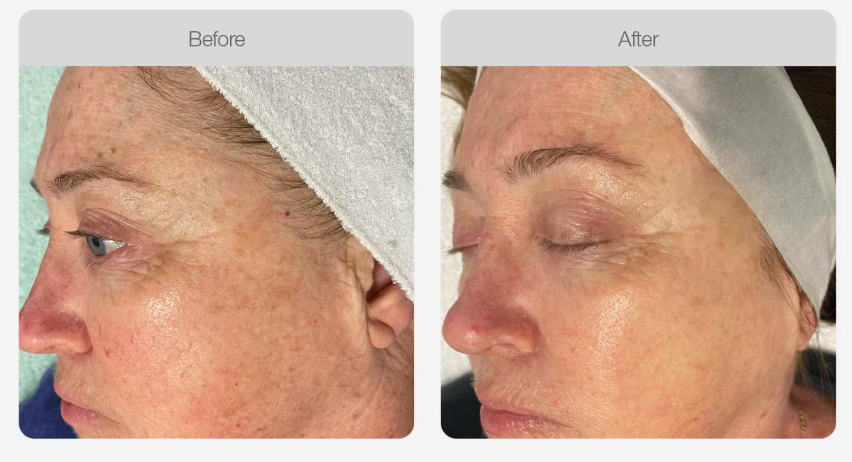 Pigmentation Skin Tone Correction