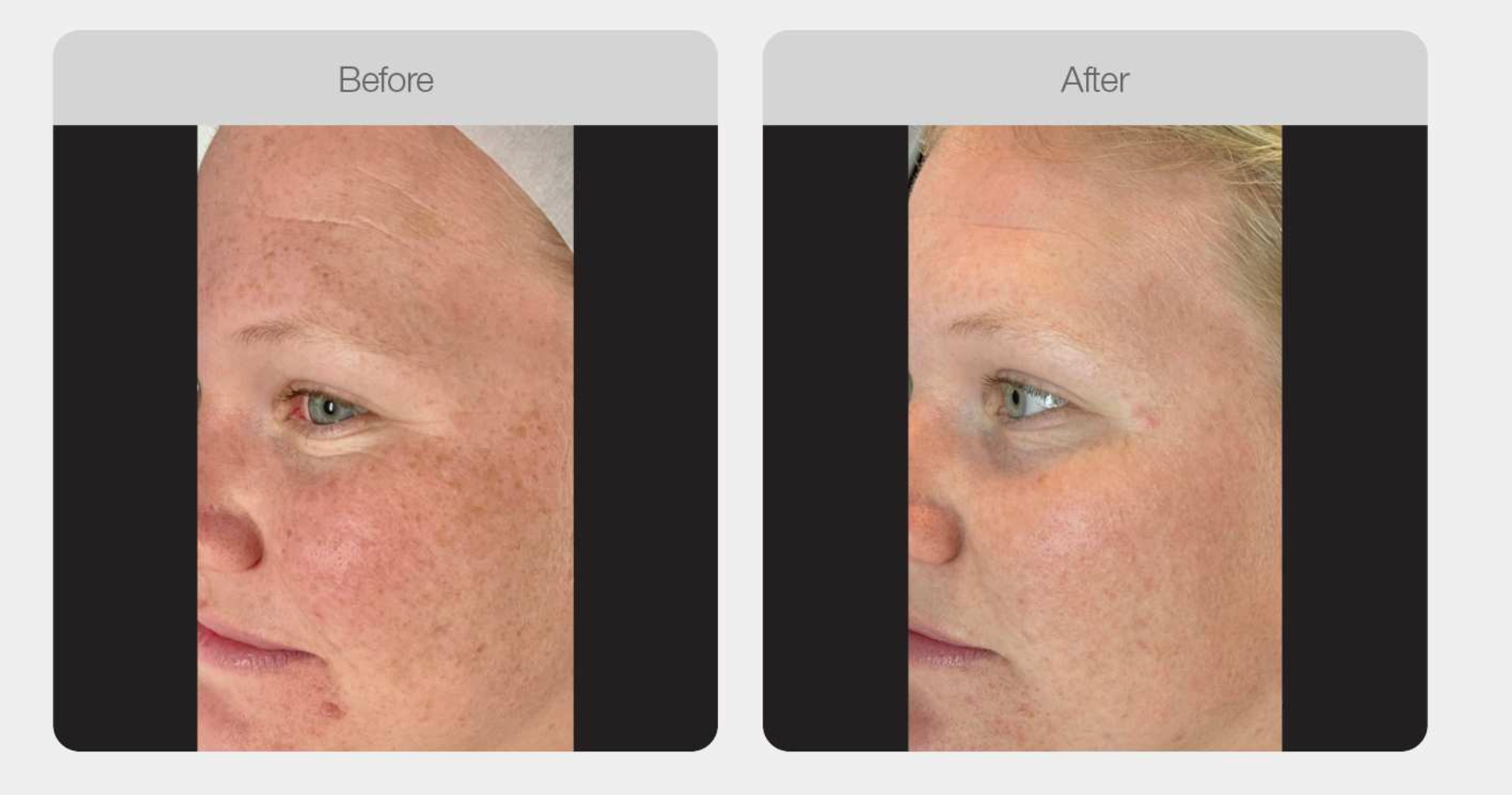 Pigmentation Skin Tone Correction