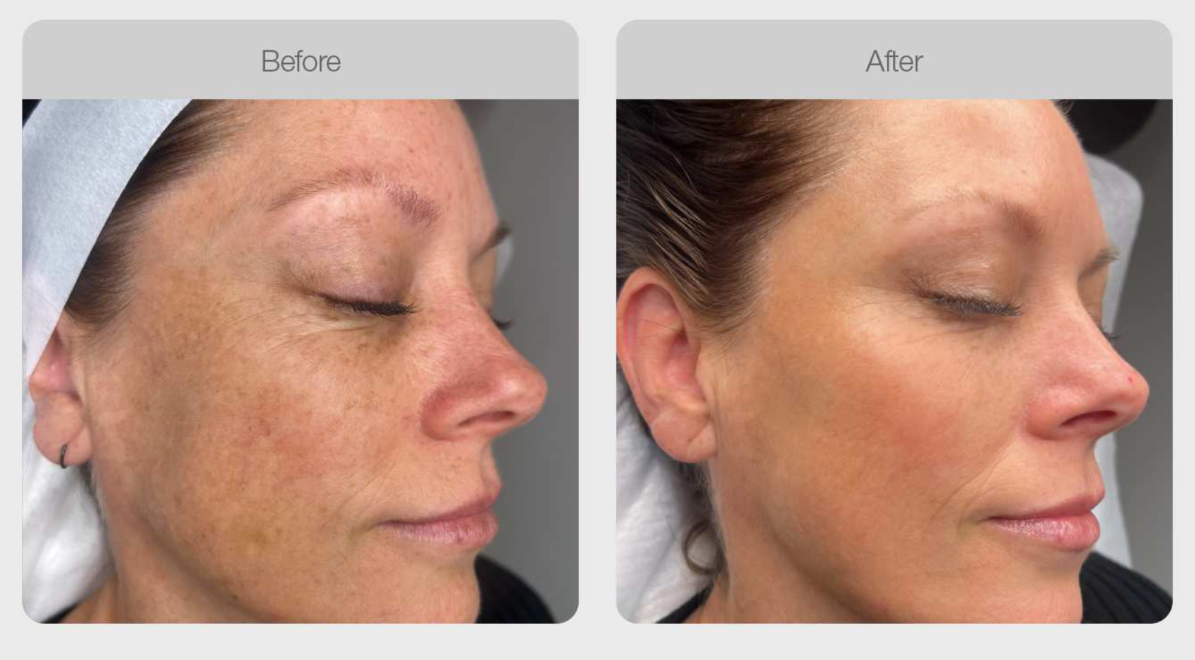 Pigmentation Skin Tone Correction