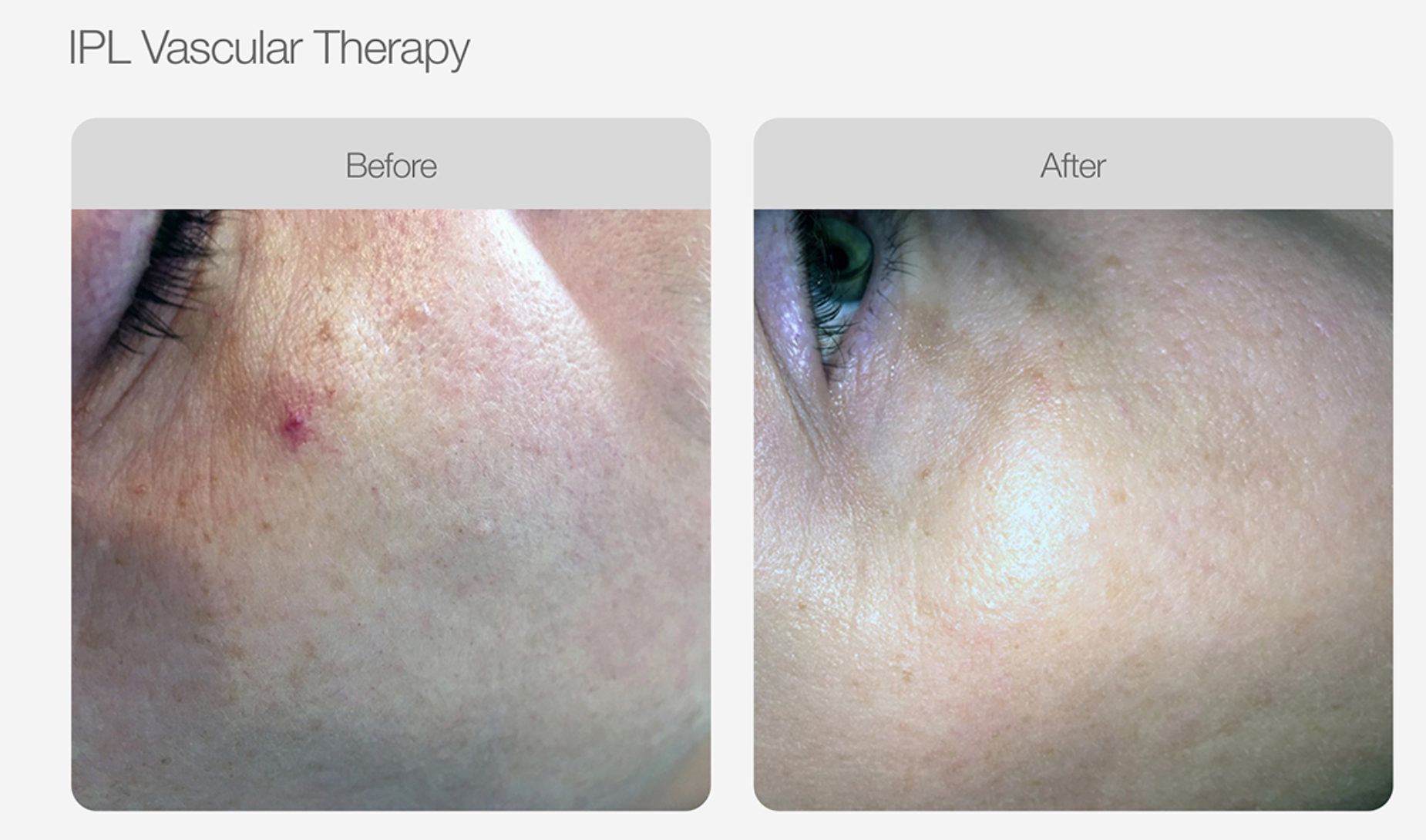 Redness Reduction