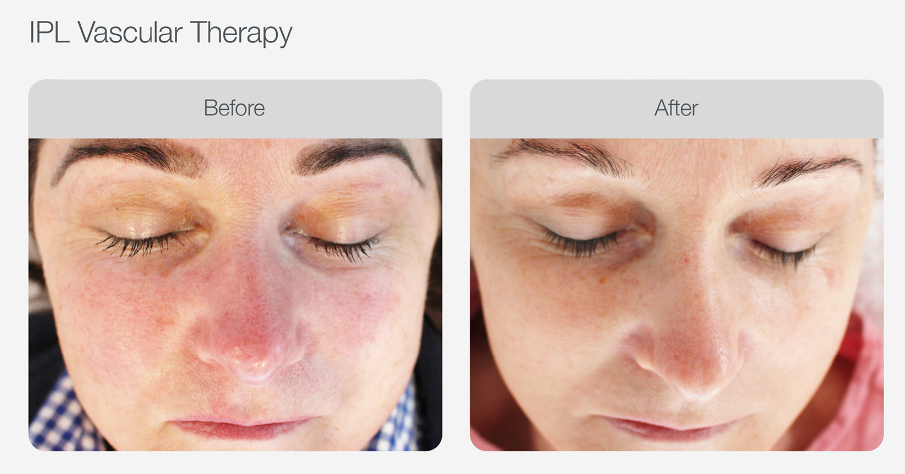 Redness Reduction