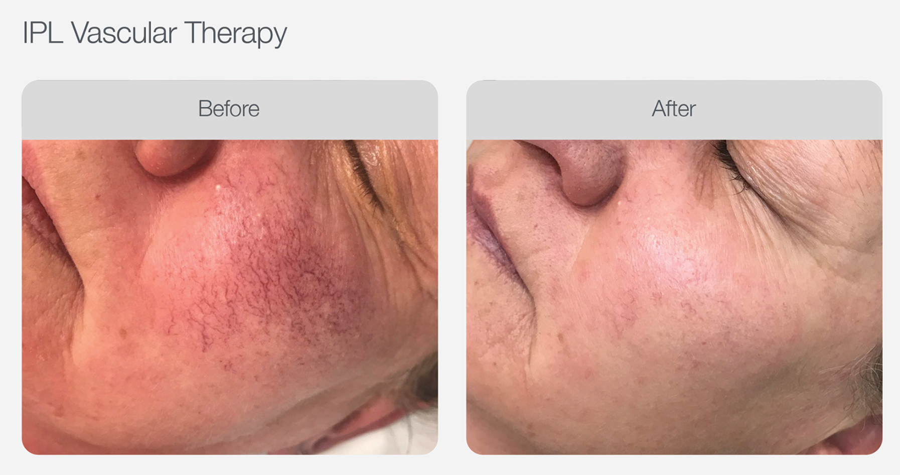 Redness Reduction